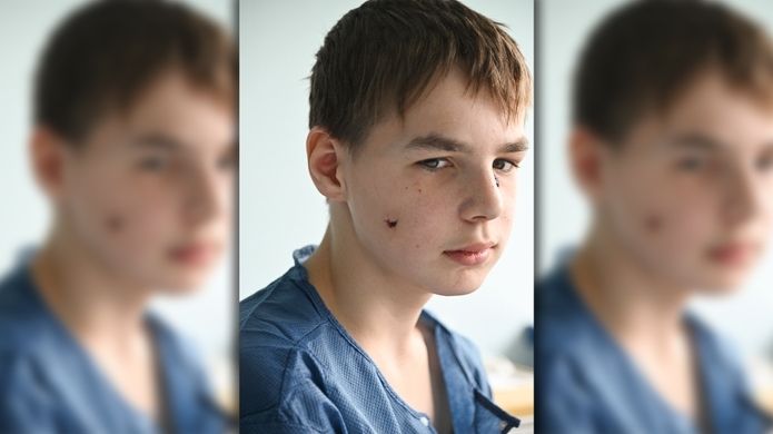 O tvář ho připravila ruská bomba. Slovenští chirurgové ji ukrajinskému chlapci vrátili